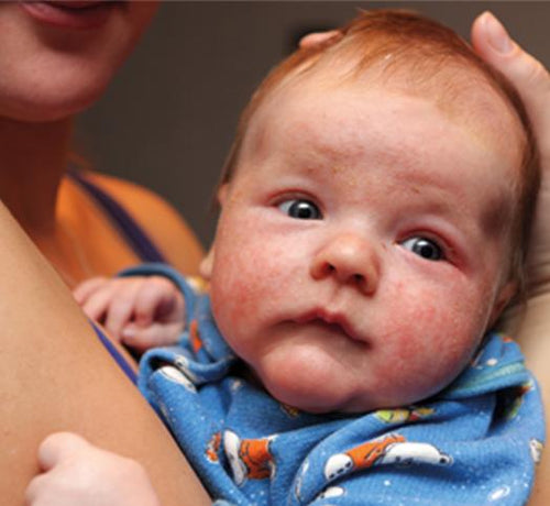 Czy atopowe zapalenie skóry jest chorobą alergiczną? - Mustela Poland - 1