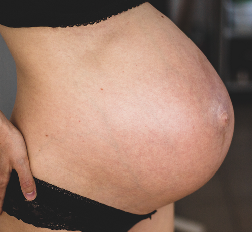 Rozejście mięśnia prostego brzucha - Mustela Poland - 1