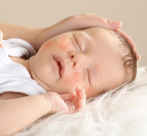 Atopowe zapalenie skóry - Mustela Poland - 1