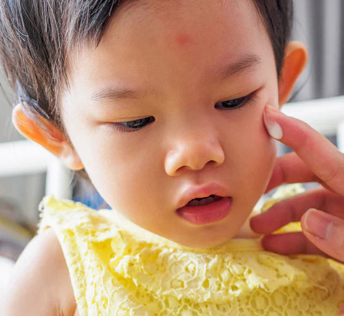 Jak złagodzić i leczyć swędzenie towarzyszące AZS u dziecka? - Mustela Poland - 1