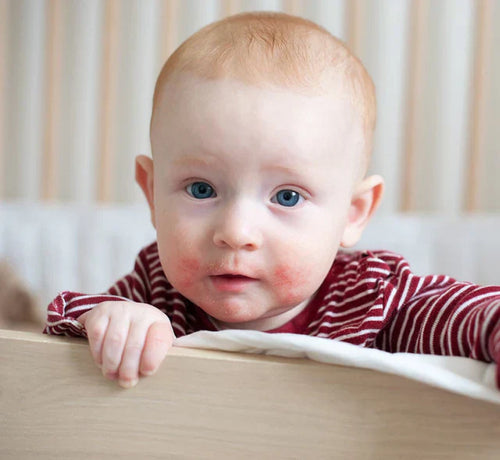 Czy egzema mojego dziecka się poprawi? - Mustela Poland - 1