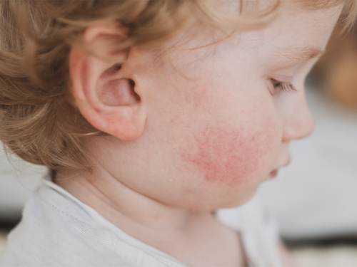 Zdjęcie do artykułu: Pokrzywka alergiczna u dzieci - skąd się bierze, jak wygląda i co możesz zrobić jako rodzic? - Mustela Poland - 1