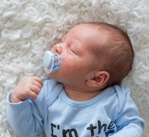 Potówki u niemowląt – jak sobie z nimi poradzić? - blog Mustela