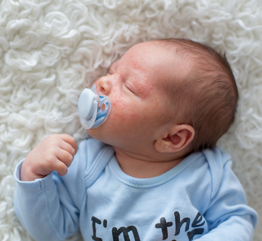Trądzik niemowlęcy – czym się różni od potówek