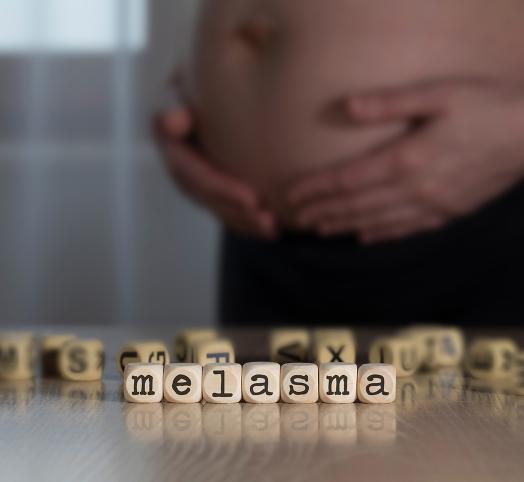 melasma ciążowa