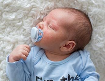 Potówki u niemowląt – jak sobie z nimi poradzić? - blog Mustela
