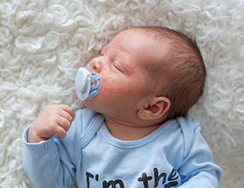 Trądzik niemowlęcy – czym jest i jak sobie z nim radzić?